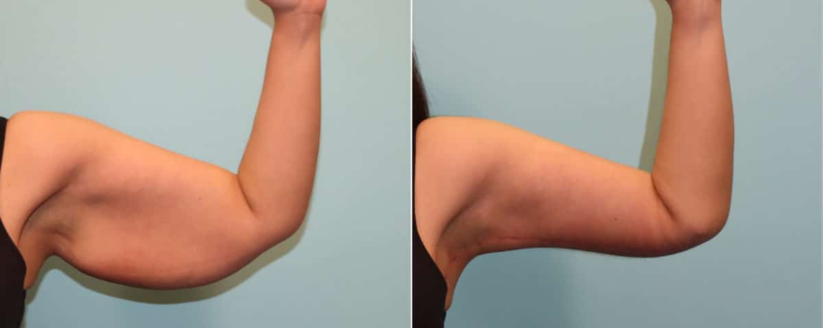 Before and after Brachioplasty (Arm Lift) by Dr. Shervin Naderi, Patient 23639