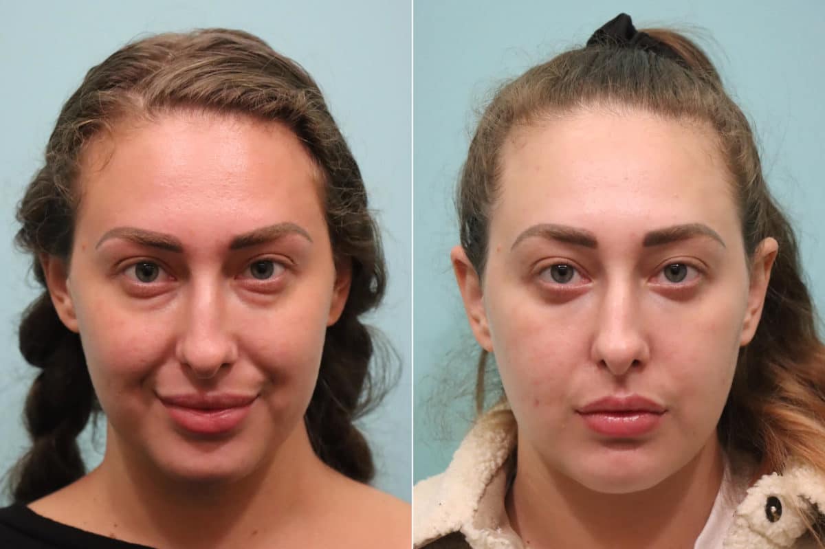 Before and after Blepharoplasty by Dr. Shervin Naderi, Patient 23655