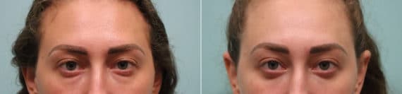 Before and after Blepharoplasty by Dr. Shervin Naderi, Patient 23655