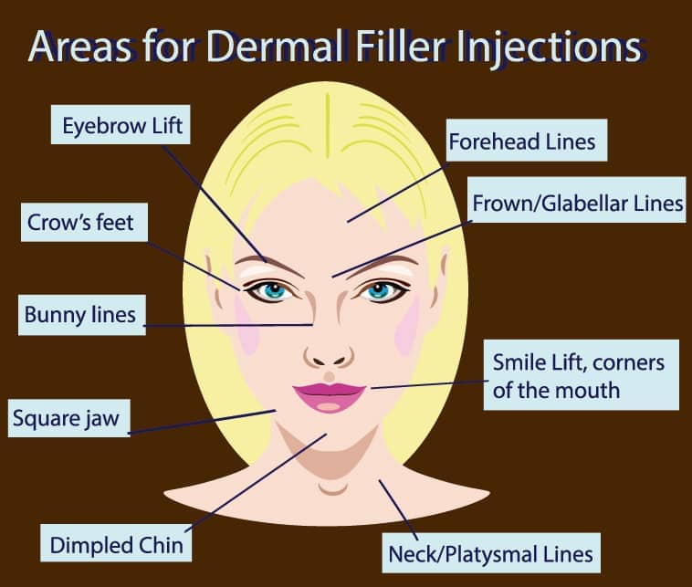 Today the scope of treatment areas for dermal fillers includes a broad range of facial concerns