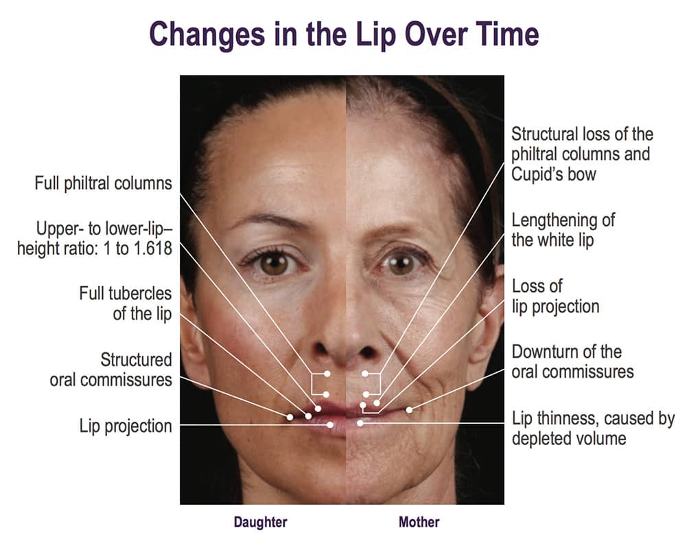 As we age many changes occur within the lips such as loss of lip projection, lengthening of the "white lip," loss of the cupid's bow, loss of lip volume and consequently formation of oral commisures or "lip lines." Reston, Virginia