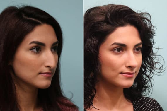 Before and after Rhinoplasty by Dr. Shervin Naderi, Patient 23959