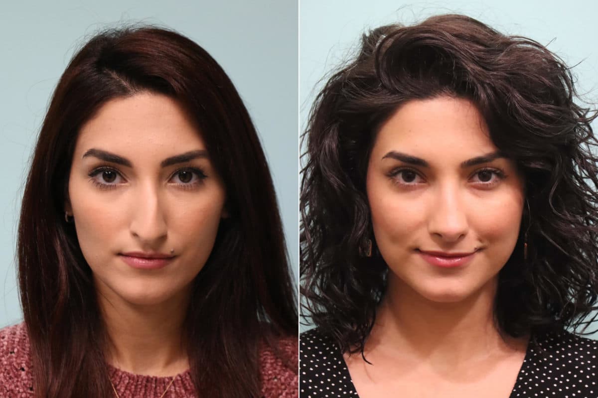 Before and after Rhinoplasty by Dr. Shervin Naderi, Patient 23959