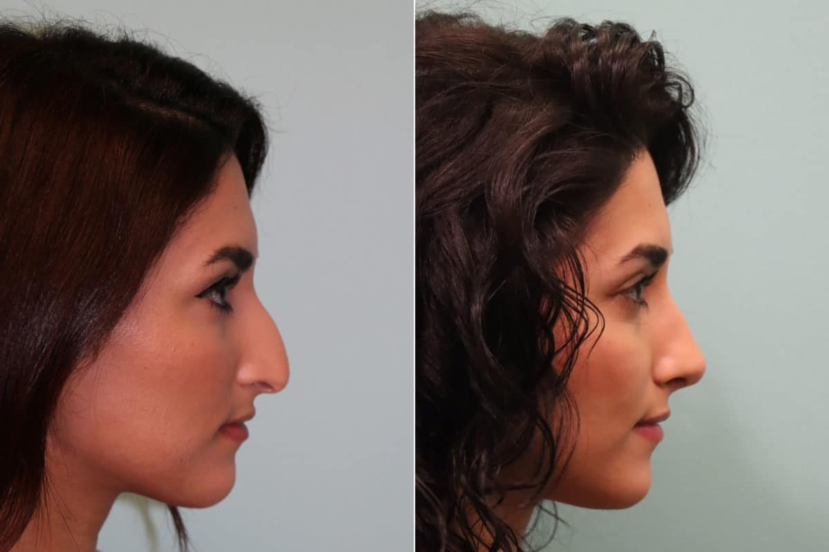 Before and after Rhinoplasty by Dr. Shervin Naderi, Patient 23959