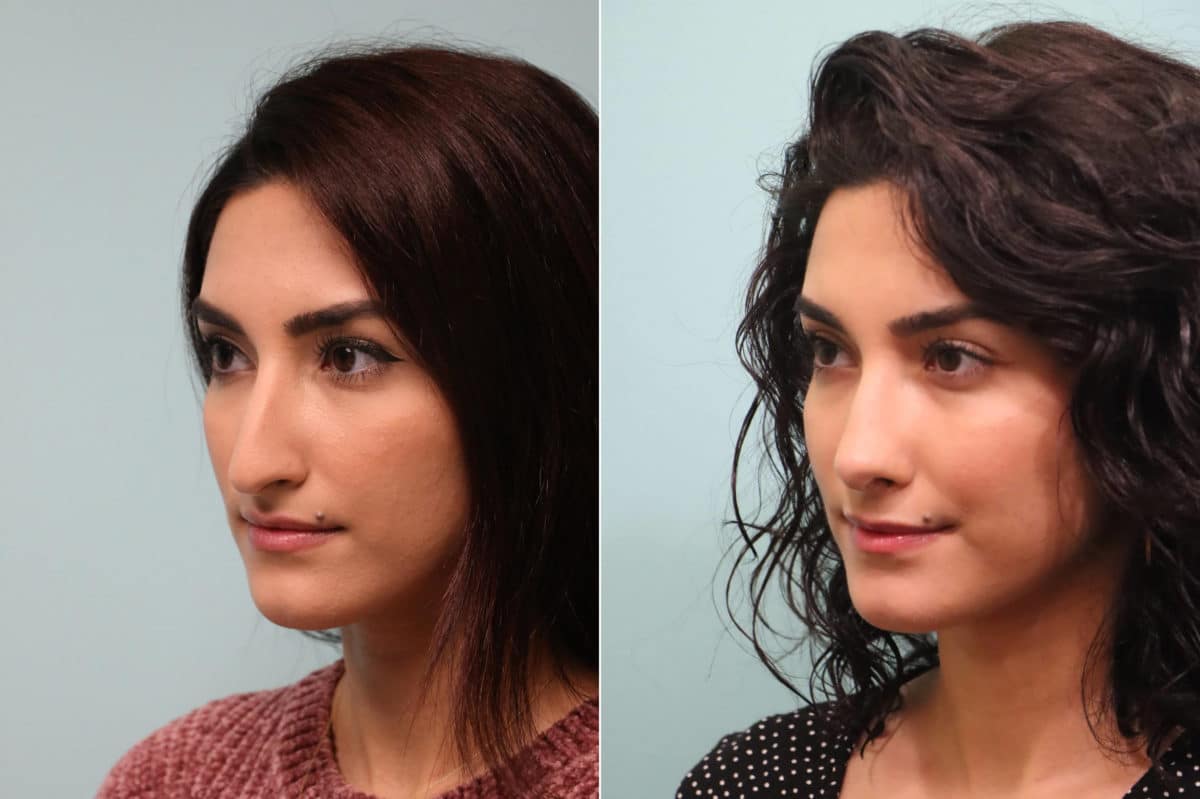 Before and after Rhinoplasty by Dr. Shervin Naderi, Patient 23959