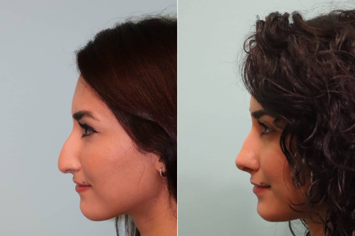 Before and after Rhinoplasty by Dr. Shervin Naderi, Patient 23959