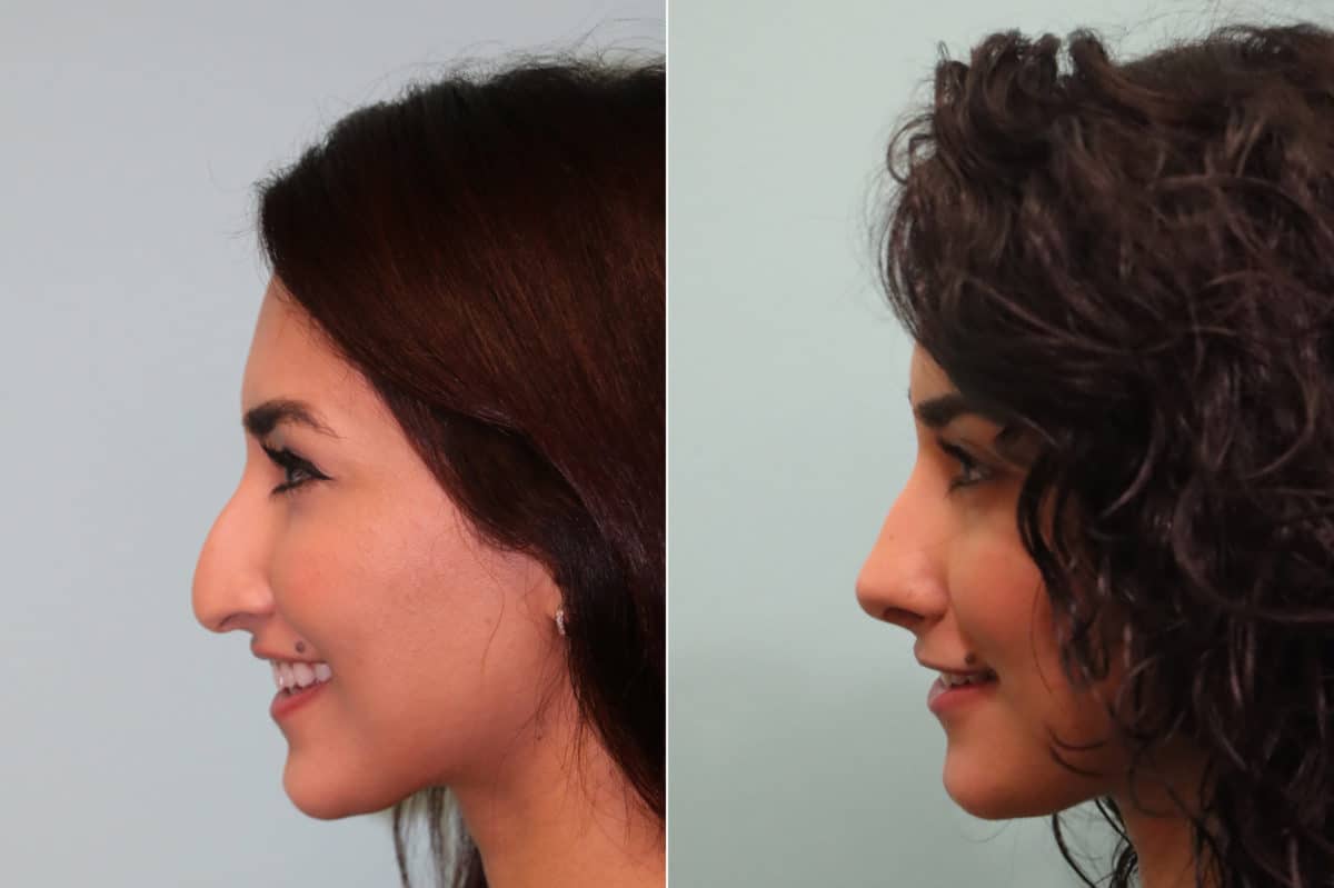 Before and after Rhinoplasty by Dr. Shervin Naderi, Patient 23959