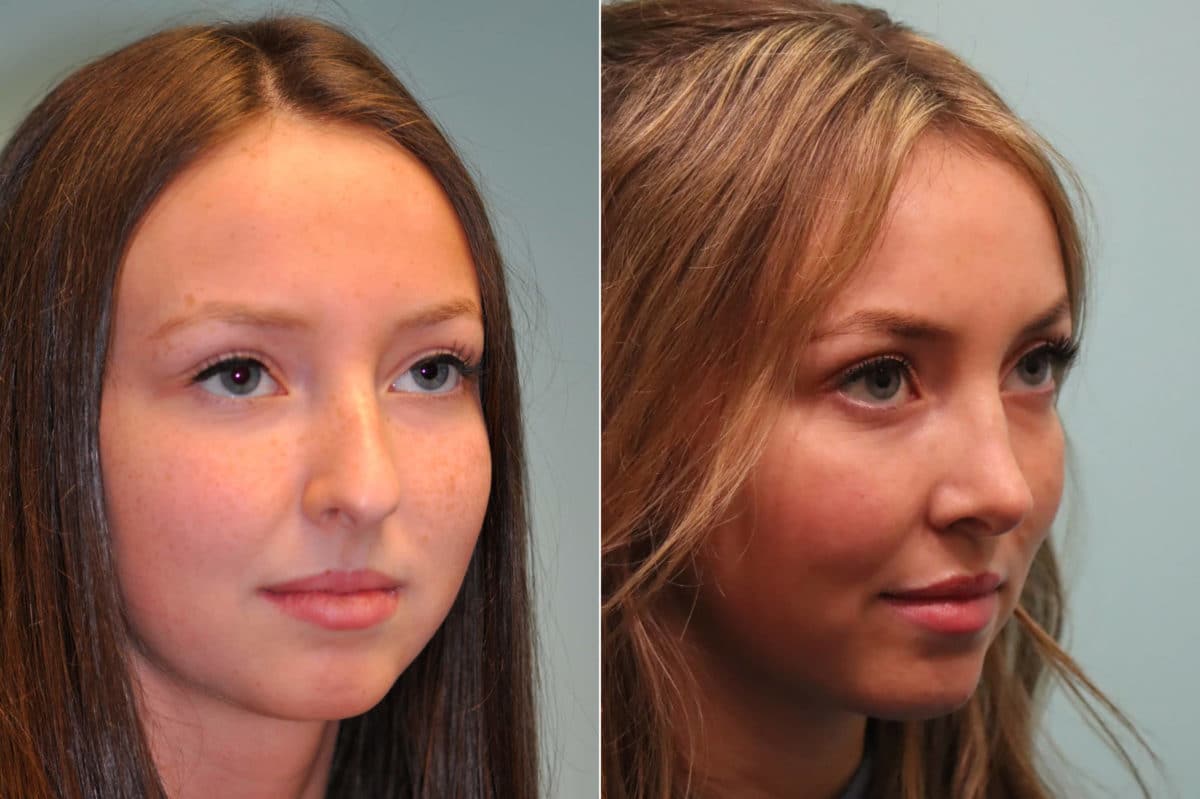 Before and after Rhinoplasty by Dr. Shervin Naderi, Patient 23978