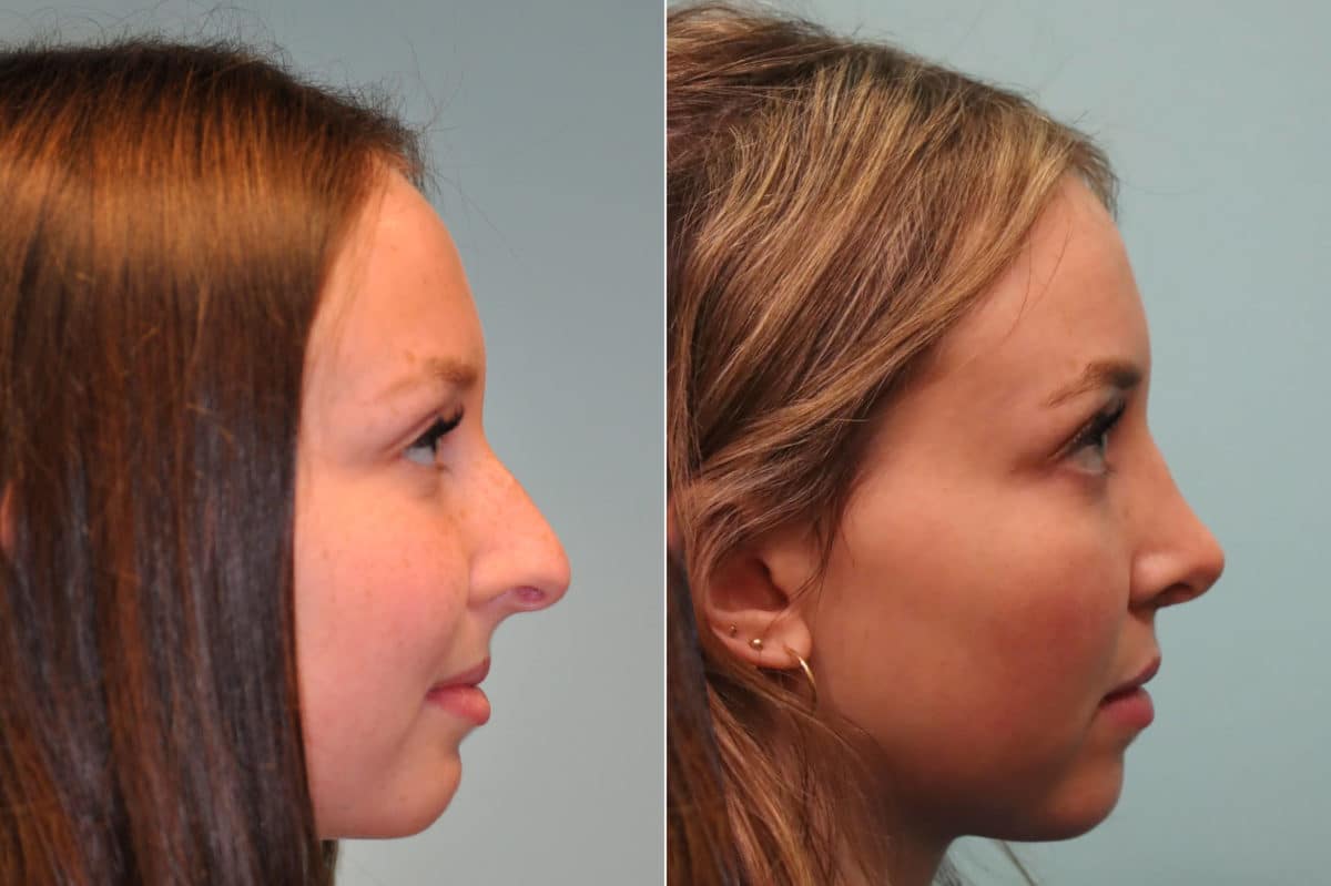 Before and after Rhinoplasty by Dr. Shervin Naderi, Patient 23978