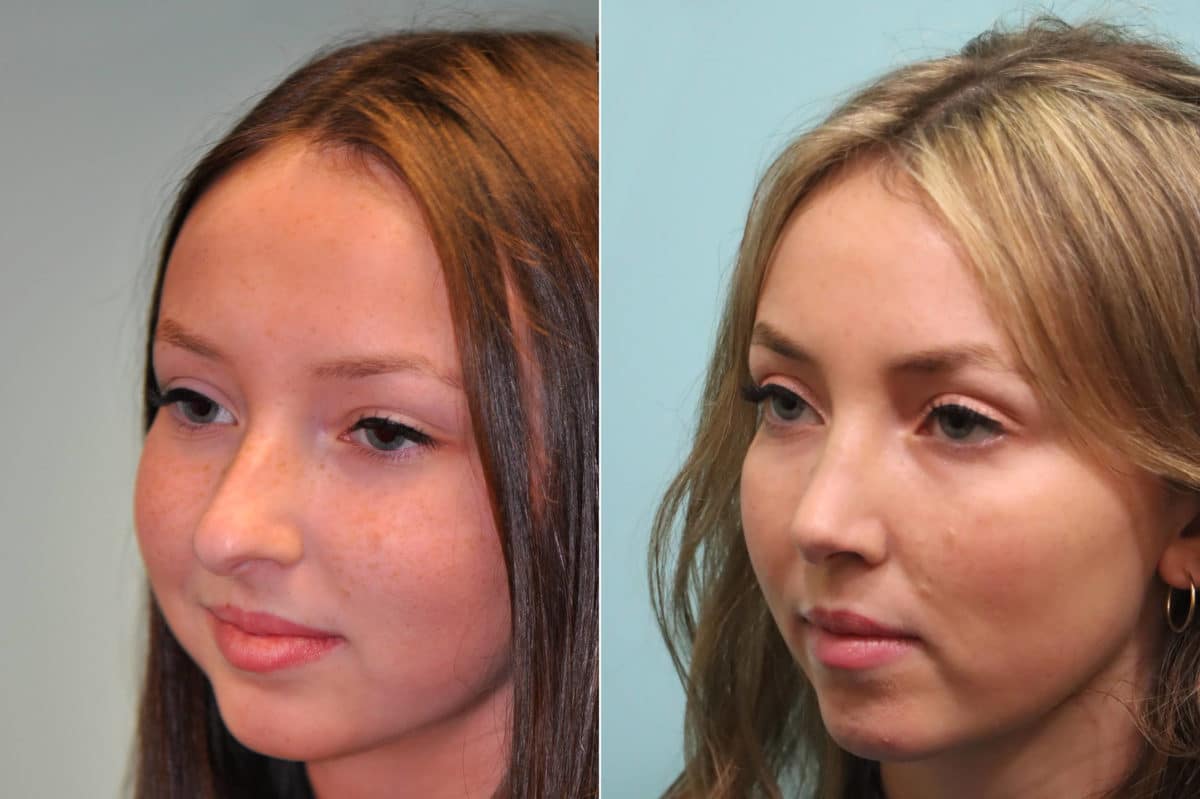 Before and after Rhinoplasty by Dr. Shervin Naderi, Patient 23978