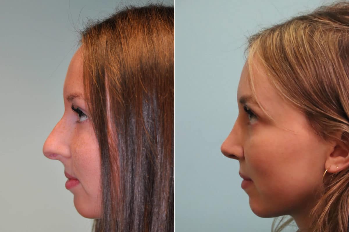 Before and after Rhinoplasty by Dr. Shervin Naderi, Patient 23978