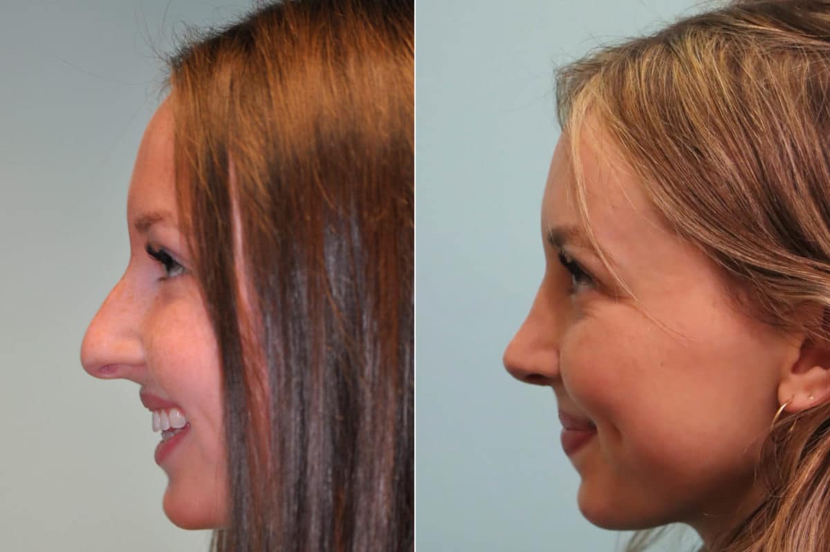 Before and after Rhinoplasty by Dr. Shervin Naderi, Patient 23978