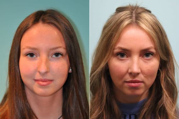 Before and after Rhinoplasty by Dr. Shervin Naderi, Patient 23978