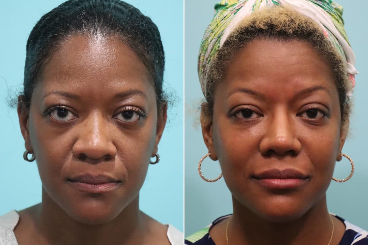 Before and after Cheeks / Midface Injections by Dr. Shervin Naderi, Patient 23178