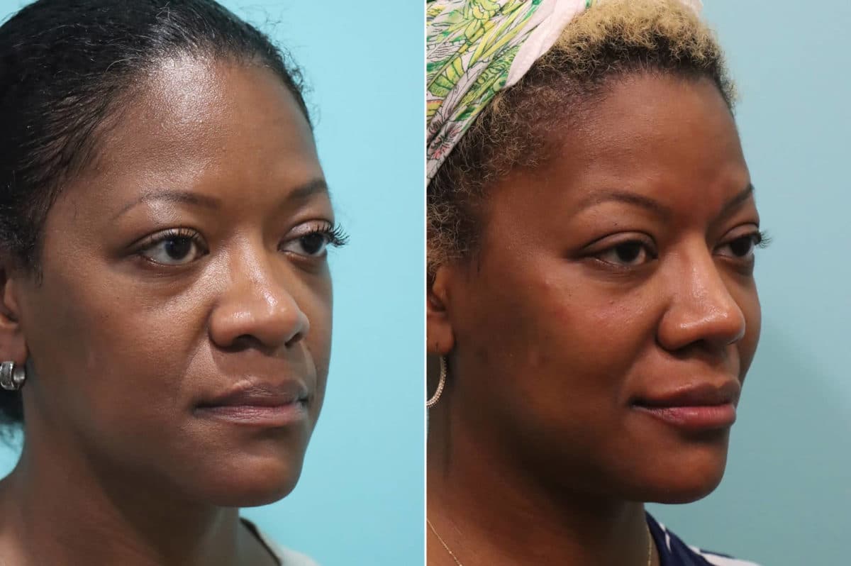 Before and after Cheeks / Midface Injections by Dr. Shervin Naderi, Patient 23178