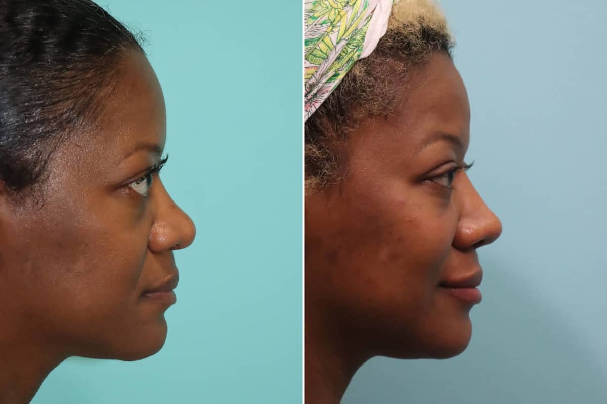 Before and after Cheeks / Midface Injections by Dr. Shervin Naderi, Patient 23178