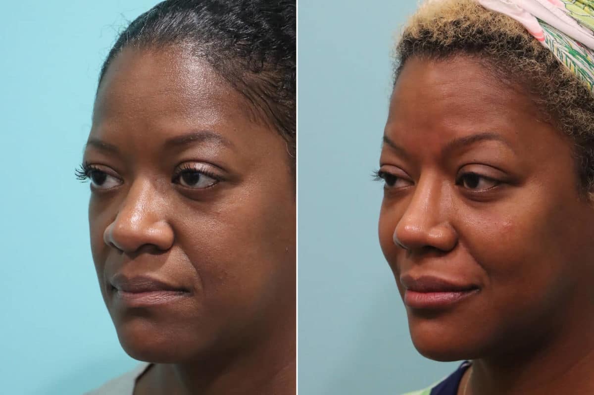 Before and after Cheeks / Midface Injections by Dr. Shervin Naderi, Patient 23178