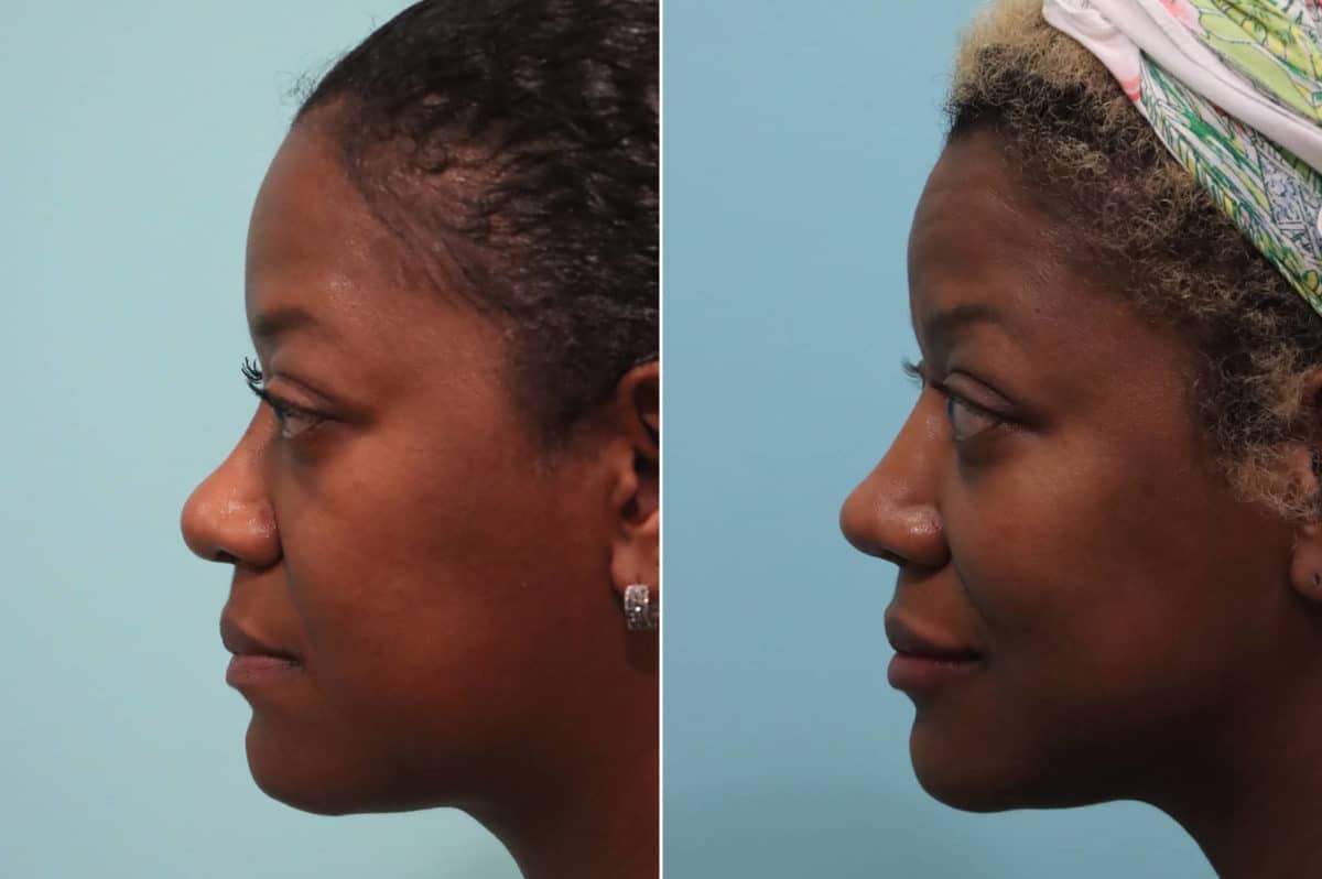 Before and after Cheeks / Midface Injections by Dr. Shervin Naderi, Patient 23178