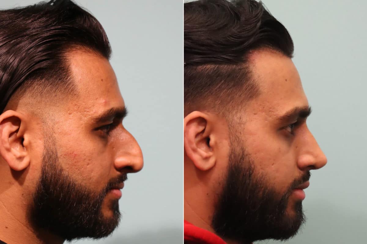 Before and after Rhinoplasty by Dr. Shervin Naderi, Patient 24096