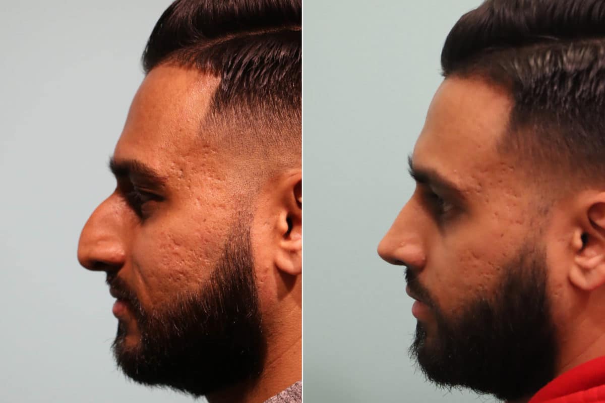 Before and after Rhinoplasty by Dr. Shervin Naderi, Patient 24096