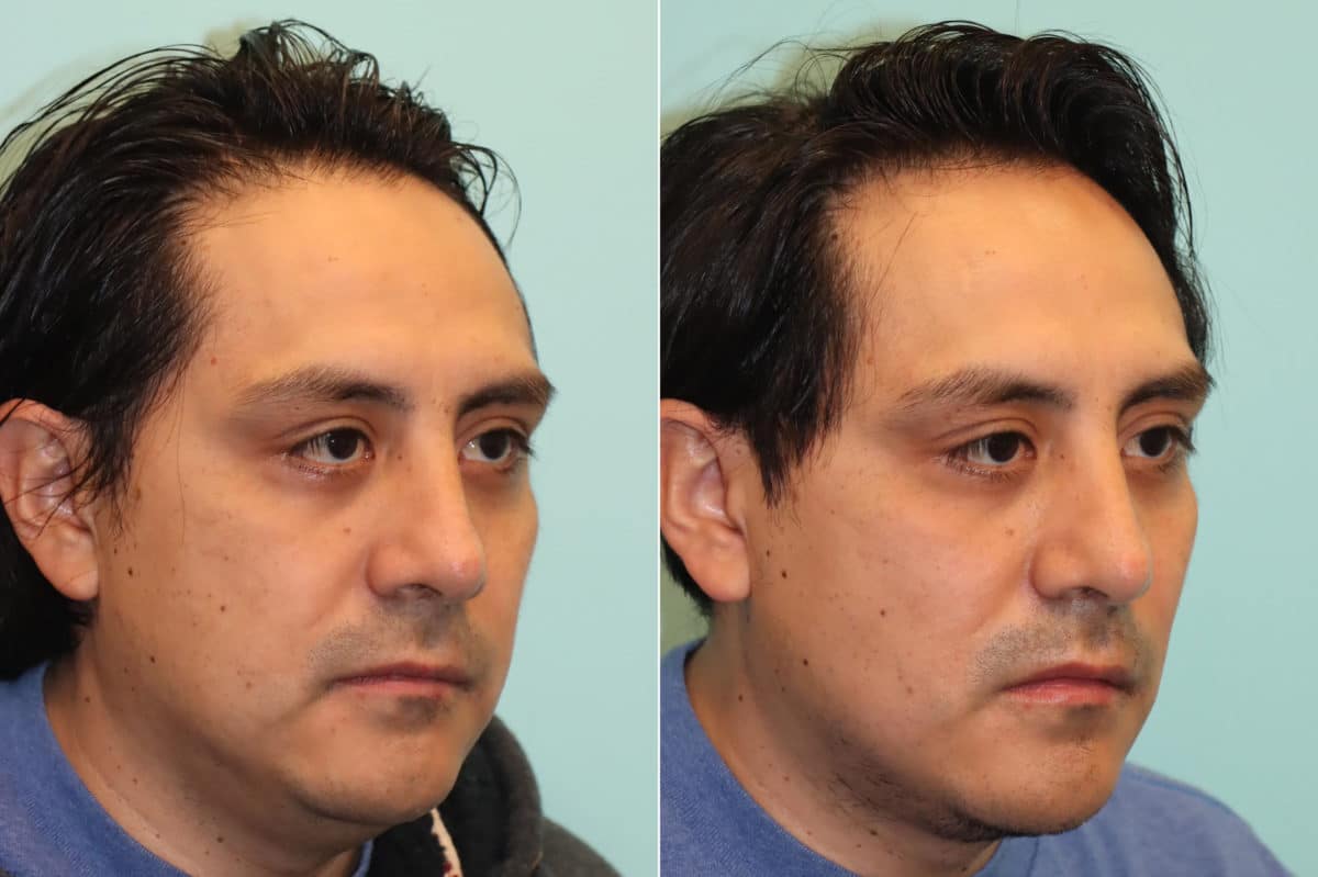 Before and after Submentoplasty by Dr. Shervin Naderi, Patient 24121