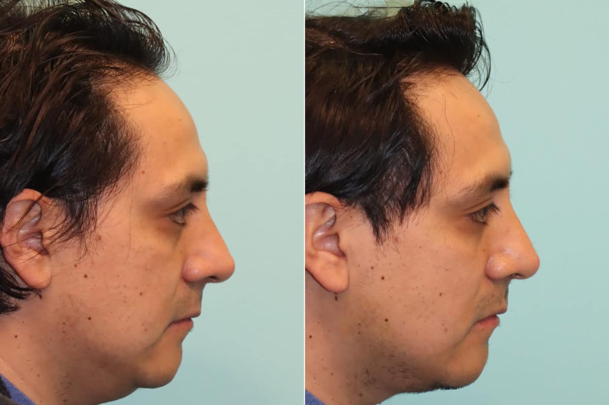 Before and after Submentoplasty by Dr. Shervin Naderi, Patient 24121