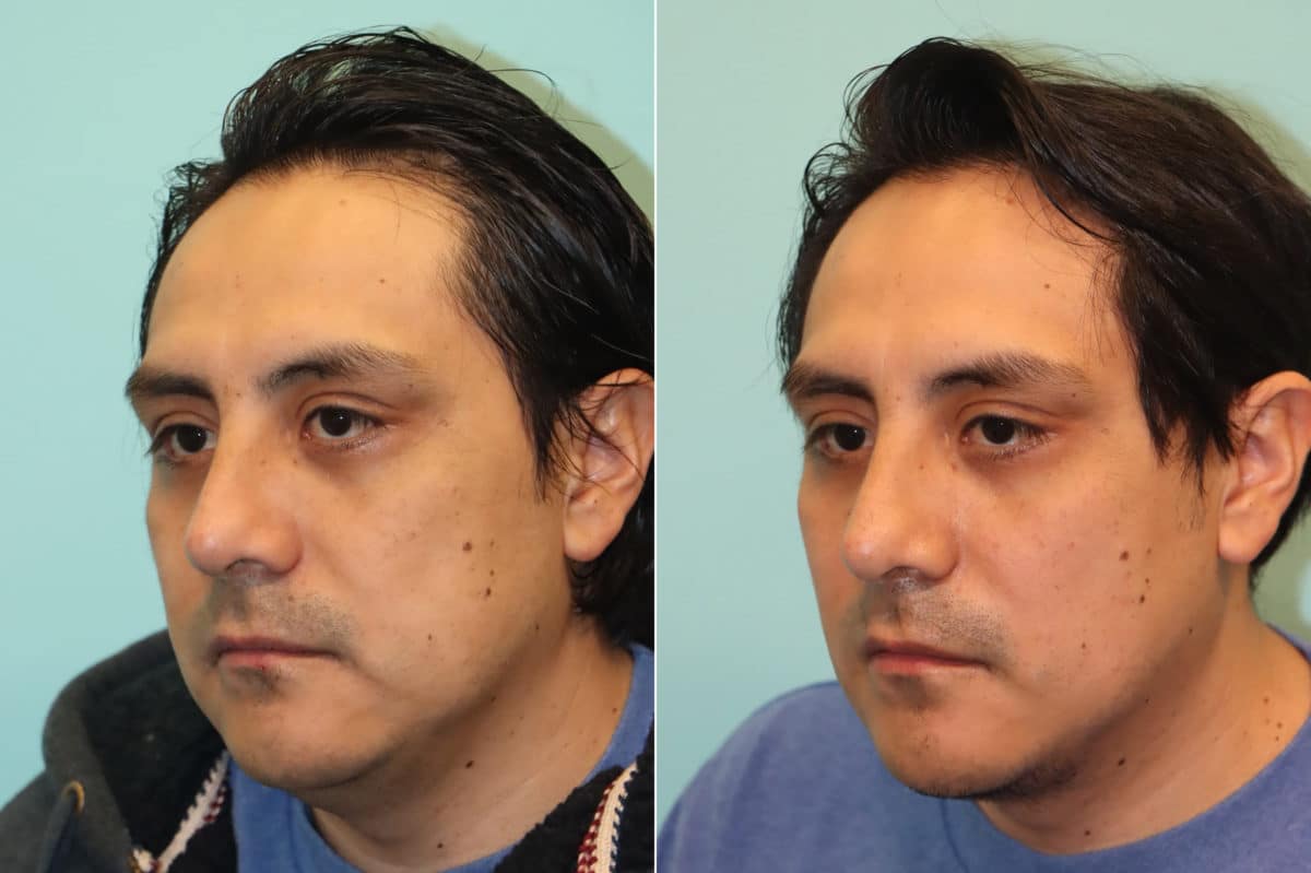 Before and after Submentoplasty by Dr. Shervin Naderi, Patient 24121