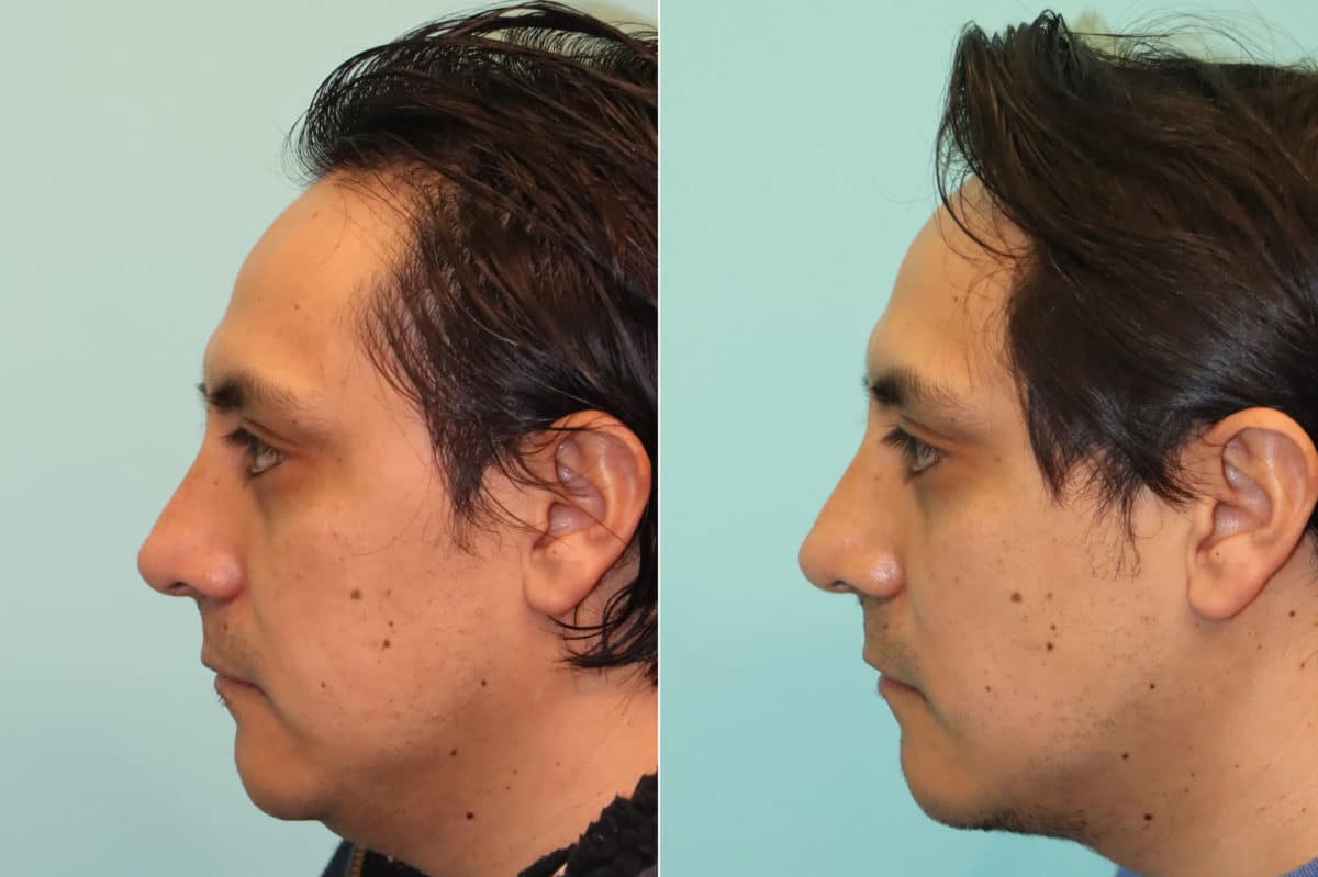 Before and after Submentoplasty by Dr. Shervin Naderi, Patient 24121