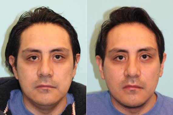 Before and after Submentoplasty by Dr. Shervin Naderi, Patient 24121