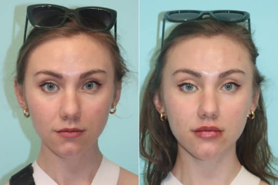 Before and after Lip Augmentation by Dr. Shervin Naderi, Patient 24140