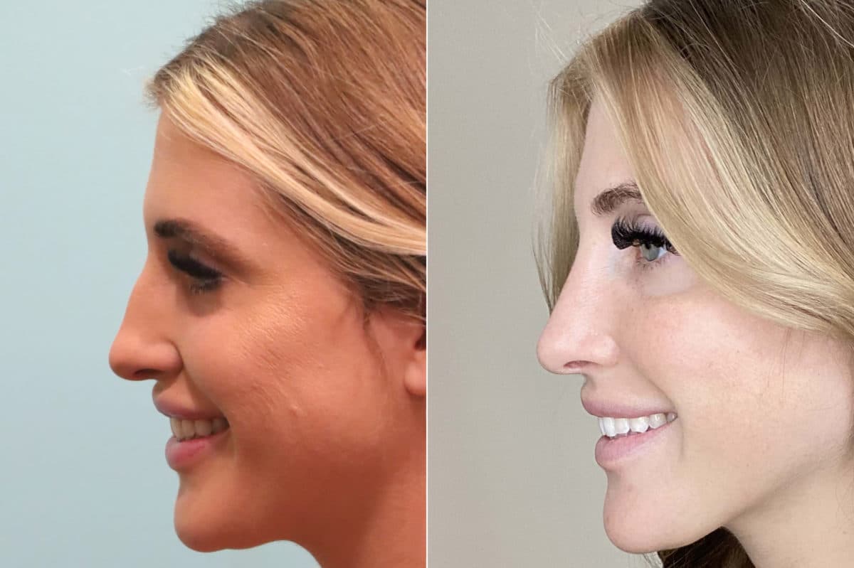 Before and after Rhinoplasty by Dr. Shervin Naderi, Patient 24153