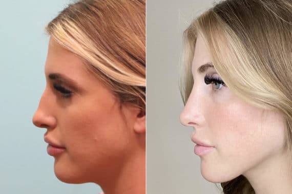 Before and after Rhinoplasty by Dr. Shervin Naderi, Patient 24153