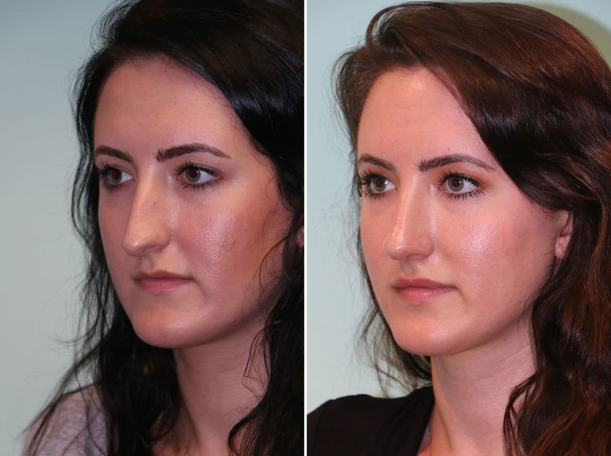 Before and after Rhinoplasty by Dr. Shervin Naderi, Patient 14178