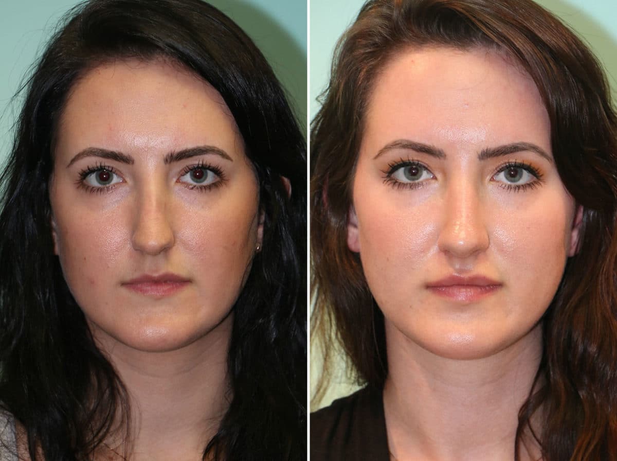 Before and after Rhinoplasty by Dr. Shervin Naderi, Patient 14178