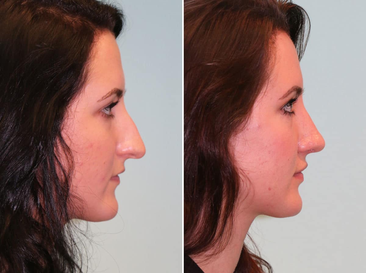 Before and after Rhinoplasty by Dr. Shervin Naderi, Patient 14178