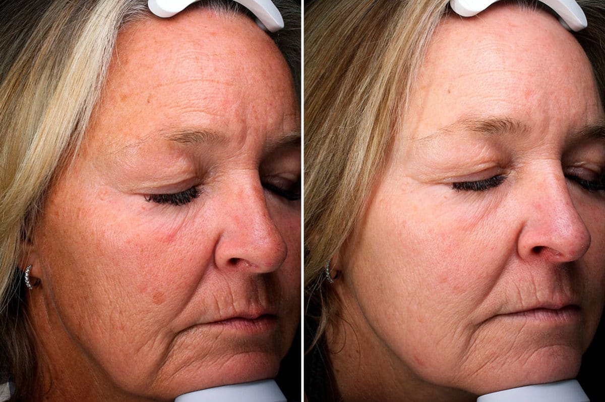 Before and after Laser Treatments by Dr. Shervin Naderi, Patient 15933