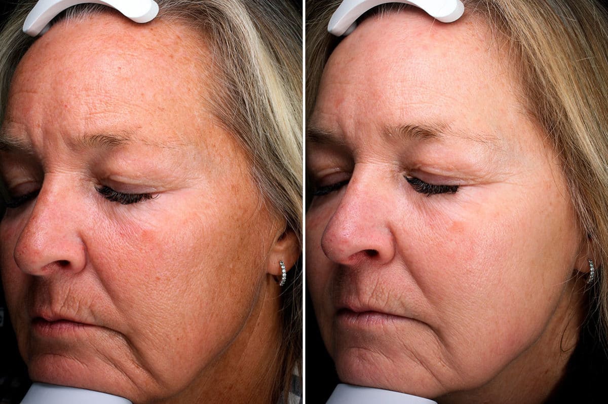 Before and after Laser Treatments by Dr. Shervin Naderi, Patient 15933