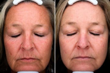 Before and after Laser Treatments by Dr. Shervin Naderi, Patient 15933