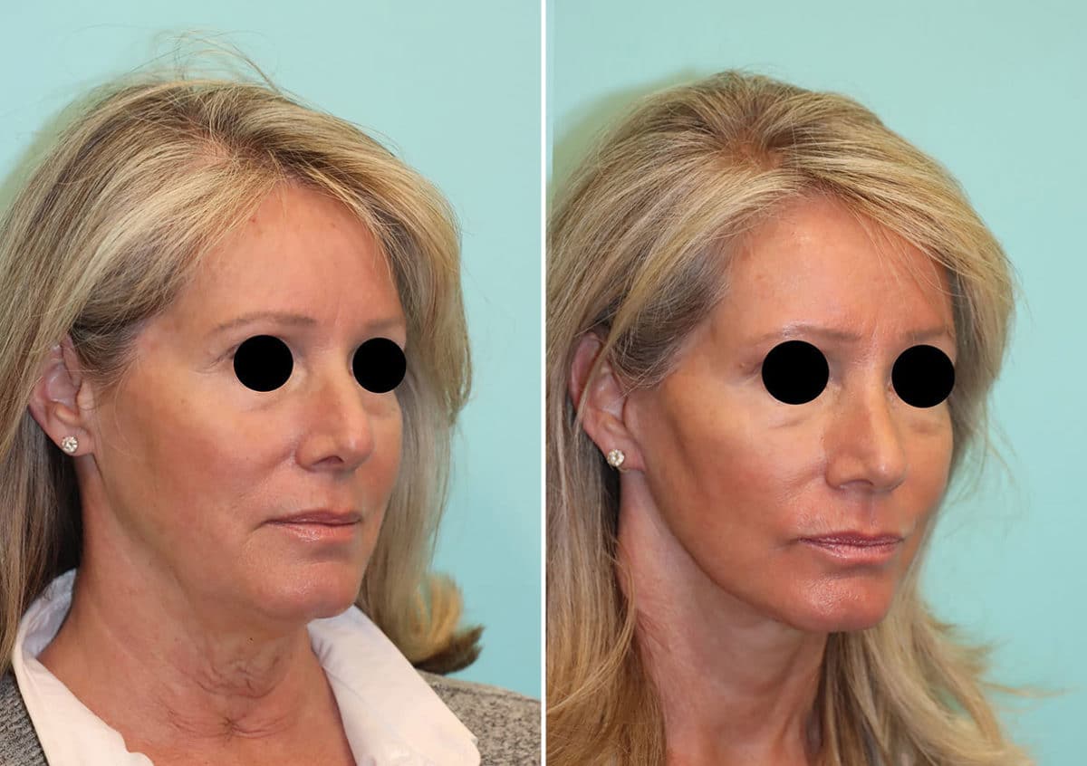 Before and after Facelift by Dr. Shervin Naderi, Patient 24251