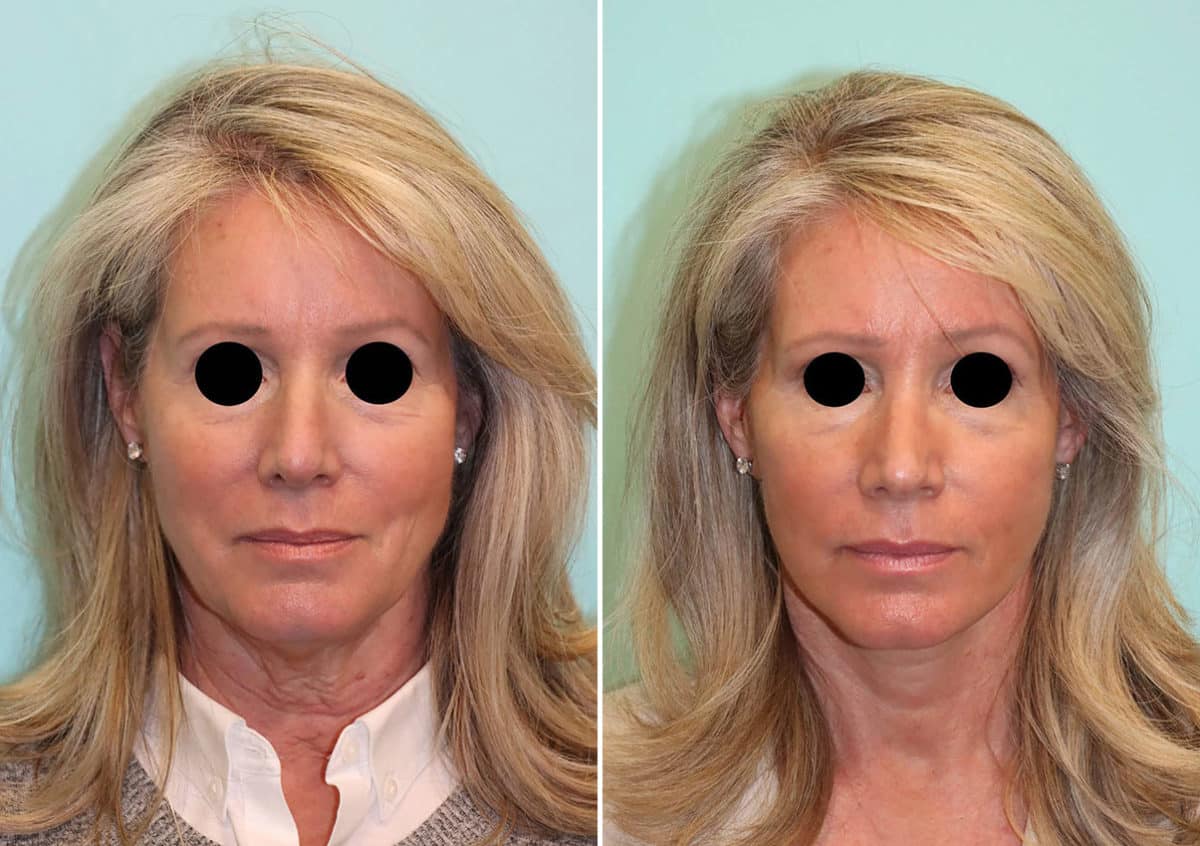 Before and after Facelift by Dr. Shervin Naderi, Patient 24251