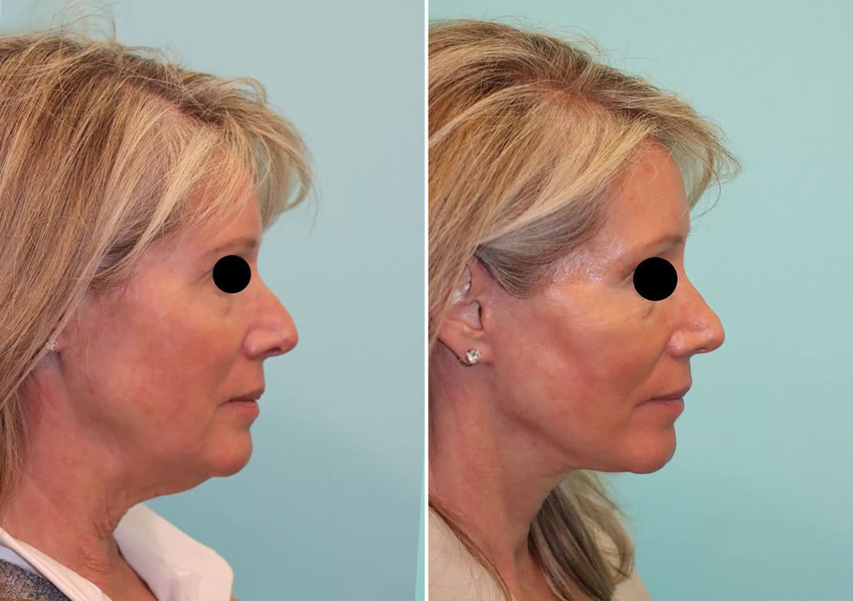 Before and after Facelift by Dr. Shervin Naderi, Patient 24251