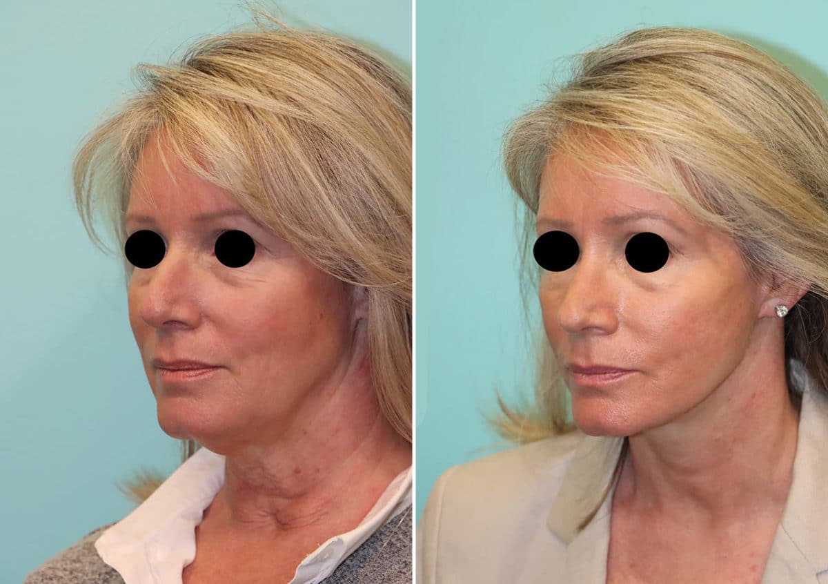 Before and after Facelift by Dr. Shervin Naderi, Patient 24251