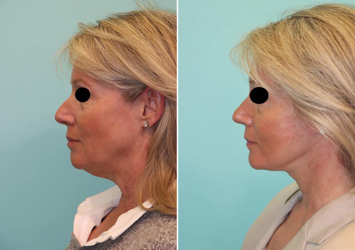 Before and after Facelift by Dr. Shervin Naderi, Patient 24251