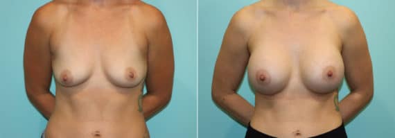 Before and after Breast Augmentation by Dr. Shervin Naderi, Patient 24270