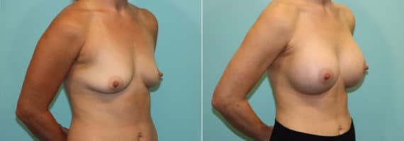 Before and after Breast Augmentation by Dr. Shervin Naderi, Patient 24270