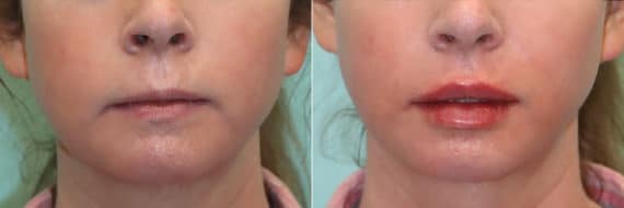 Before and after Lip Augmentation by Dr. Shervin Naderi, Patient 24347