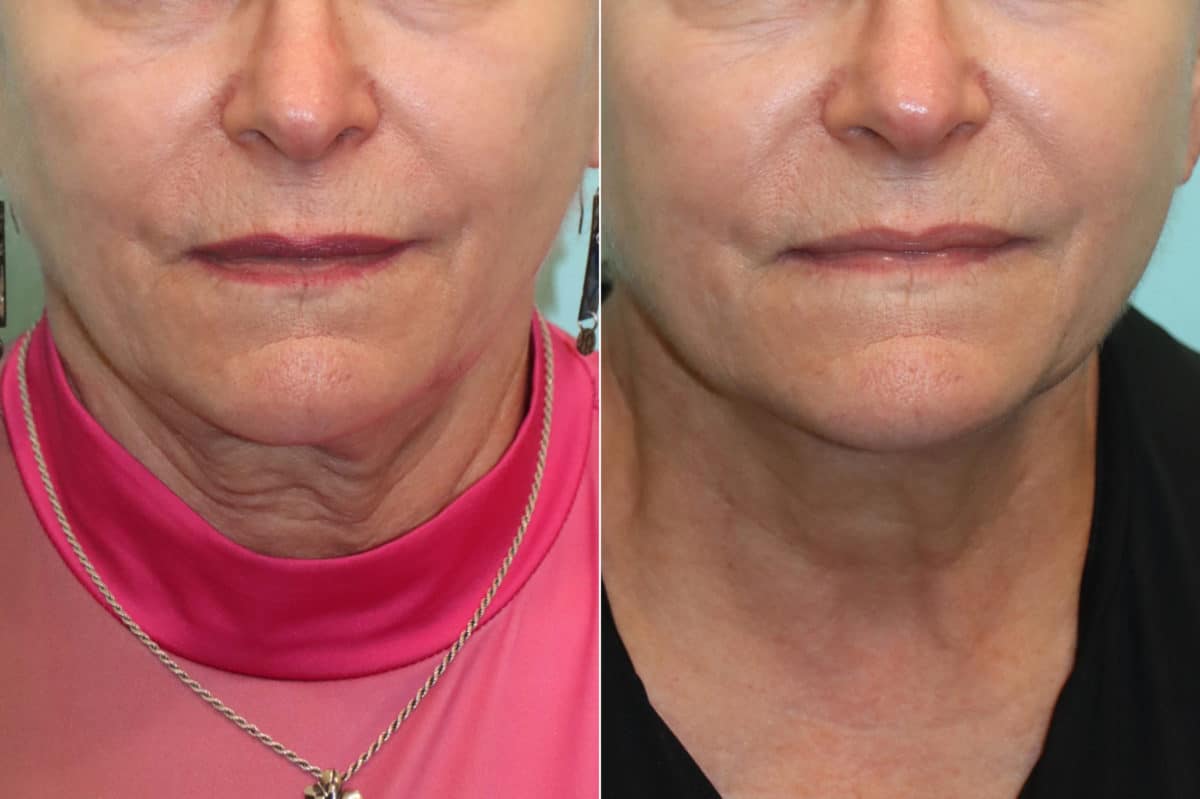 Before and after Morpheus8 by Dr. Shervin Naderi, Patient 24422