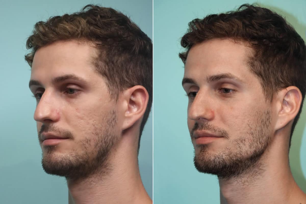 Before and after Other injections by Dr. Shervin Naderi, Patient 24439