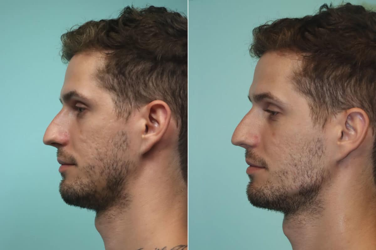 Before and after Other injections by Dr. Shervin Naderi, Patient 24439