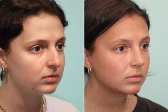 Before and after Rhinoplasty by Dr. Shervin Naderi, Patient 24476